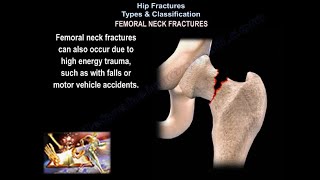 Hip Fractures Types amp Classifications  Everything You Need To Know  Dr Nabil Ebraheim [upl. by Brittan250]