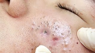 Big Cystic Acne Blackheads Extraction Blackheads amp Milia Whiteheads Removal Pimple Popping  5068 [upl. by Chatav822]