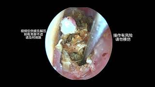 Cleaning a large amount of earwax that severely blocks the ear canal earwaxremoval earwax cleaning [upl. by Sello]