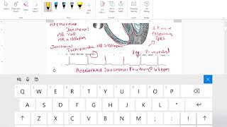 Junctional Rhythm Interpretation [upl. by Anivid]