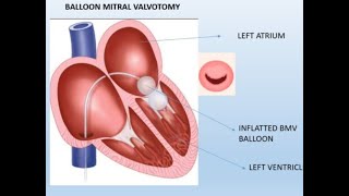 Mitral valve balloon valvuloplasty in MS patients [upl. by Alper370]