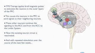 How Does TMS Therapy work [upl. by Jobe976]