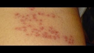 Learn About Shingles Caused by the Varicellazoster Virus [upl. by Mcclary897]