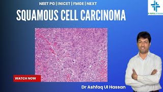 Squamous Cell Carcinoma I FMGE I NEET Pg I USMLE I PLAB I INICET I MRCP [upl. by Cerys]