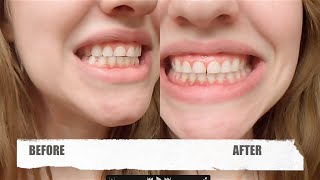 Dr Song Teeth Whitening Review Before and After 1 use [upl. by Esinwahs]