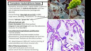 Gestational Trophoblastic Disease Kurts Notes pathagonia [upl. by Sivek246]