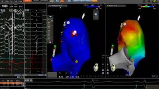 RVOT VT mapping EPstudy ablation [upl. by Helbonna]