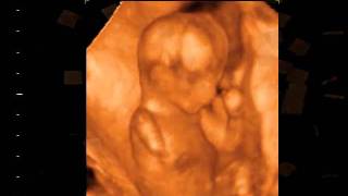 3D4D Ultrasound at 15 weeks Pictures [upl. by Leopoldine997]