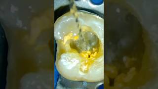 guttapercha Removal using Retreatment D1 D2  D3 Rotary files الكربولة [upl. by Adnawat781]