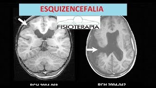 Esquizencefalia indicaciones 1 parte  Rehabilitación [upl. by Ellohcin]