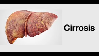 Cirrosis  Causas Síntomas Pronóstico y Tratamiento [upl. by Naujal]