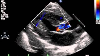 How to do pediatric echocardiography study [upl. by Cindelyn]