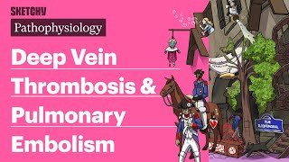 Deep Vein Thrombosis amp Pulmonary Embolism Pathophysiology  Sketchy Medical [upl. by Ajnin]