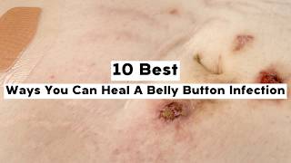 10 Best Ways You Can Heal A Belly Button Infection [upl. by Adnawal706]