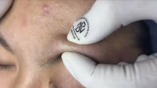 Relax EveryDay With Nhat Bang Spa 2024 Blackheads Removal On Teen [upl. by Theona]