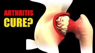 Arthritis Youre Treating It Wrong See How to Actually Repair Cartilage [upl. by Leticia]