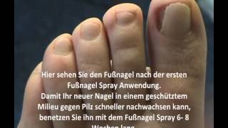 Eingerollte Fußnägel Schnell und einfach bearbeiten Fußnagel Spray [upl. by Nimar]