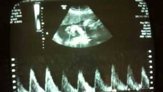 Fetal heart rate  32 week ultrasound [upl. by Artina]