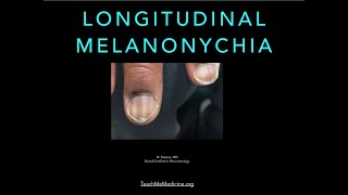 Nails Longitudinal Melanonychia [upl. by Sim39]