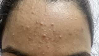 how to get rid of forehead bumps in only 1 day [upl. by Lednahs]