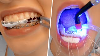 BRACES REMOVAL PROCESS  Satisfying [upl. by Ide226]