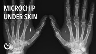 Biohax Microchip Implant  Merging with Technology [upl. by Ing509]