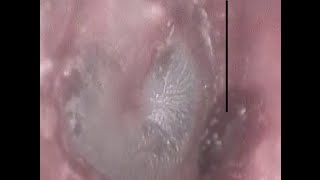 Look inside view of ear after cotton bud Q Tip itching or cleaning [upl. by Kin80]