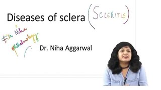 Diseases of Sclera  Dr Niha Aggarwal [upl. by Barret]