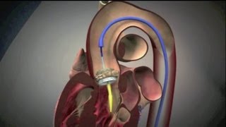 Transcatheter Aortic Valve Implantation TAVI [upl. by Nogem]