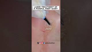 LASER TREATMENT OF A PAINFUL FOOT WART  VERRUCA 2023 BY FAMOUS FEETT SPECIALIST MISS FOOT FIXER [upl. by Wiltshire998]