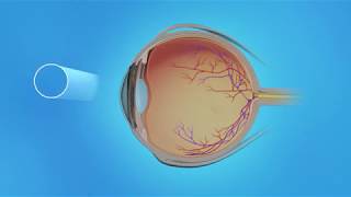 Detached Retina Vitrectomy with Scleral Buckle [upl. by Ettenahs510]