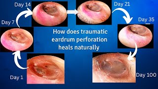 How does traumatic eardrum perforation heals [upl. by Nevs]