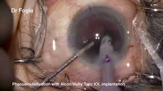 Alcon Vivity Toric IOL implantation [upl. by Korenblat572]