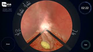 Ectopic Salpingectomy approach [upl. by Etterb]