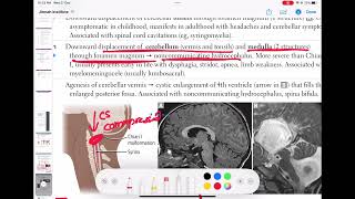 chiari 2 malformation neurology 8  First Aid USMLE Step 1 in UrduHindi [upl. by Nicole]