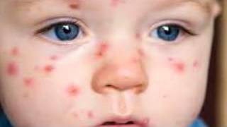 What is chickenpox Signs and symptoms of chickenpox [upl. by Anderson]