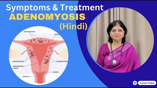 Adenomyosis of uterus  Heavy and Painful periods  क्या होता है Adenomyosis  Dr Neera Bhan [upl. by Lilaj]