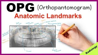 Orthopantomogram OPG Anatomical Landmarks  Radiology [upl. by Straus]