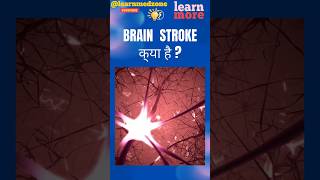 Brain Stroke  Hemorrhage  ब्रेन स्ट्रोक ब्रेन स्टोक के लक्षण [upl. by Ganley]