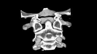 Cervical spine CT scan Atlantoaxial subluxation [upl. by Suoirrad]