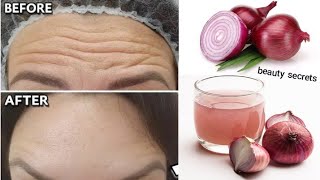 1 onion is a million times stronger than Botox it eliminates wrinkles and fine lines instantly [upl. by Norwood]