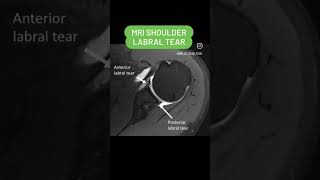 Labral Tear MRI shoulder joint shorts viral youtubeshorts [upl. by Potter]