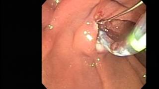 ERCP sphincterotomy stone extraction [upl. by Ahsinit]