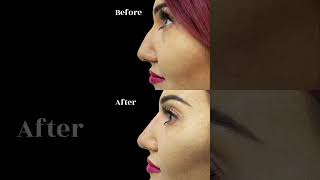 Incredible Nose Filler Transformation [upl. by Nolyaw613]