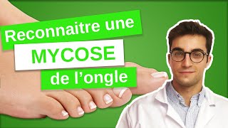 Savoir RECONNAÎTRE une MYCOSE de longle  Onychomycose 13 [upl. by Ahsenot]