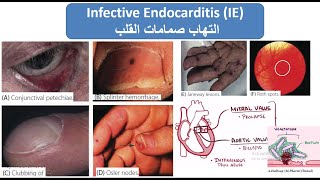 Infective Endocarditis إلتهاب صمامات القلب [upl. by Nylhtac149]