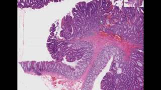 Histopathology Colon Tubular adenoma adenomatous polyp [upl. by Hayarahs497]