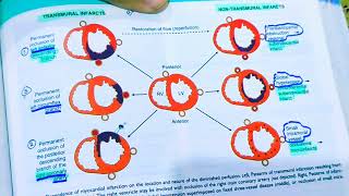 Myocardial Infarction pathologyAnterior wall MISTEMI AND NSTEMIHeart pathologyRobbins pathology [upl. by Hare]