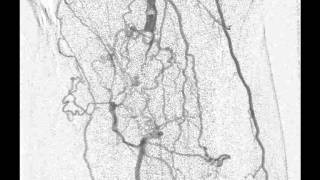 Arteriografia de membros inferiores  CIMI [upl. by Chubb]