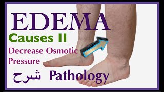 Pathology  Edema causes Decrease Osmotic Pressure  👨🏻‍⚕️ شرح باثو [upl. by Burnsed]